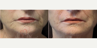 65-74 year old woman treated with Juvederm, Vollure - Treatment of nasolabial folds (laugh lines) and marionette lines with Juvederm, Radiesse, Vollure, Restylane or Bellafill injected with cannula