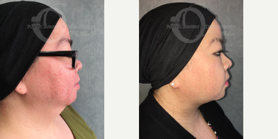 45-54 year old woman treated with Neck Lift - advanced mehr design face and neck lift