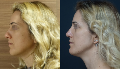 25-34 year old woman treated with Chin Surgery - Chin reduction & Rhinoplasty surgery - 2 months post-operative