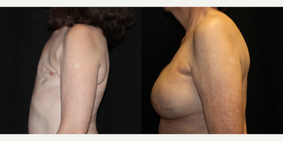 55-64 year old woman treated with Breast Reconstruction with Latissimus Flap - Bilateral Breast Reconstruction with Latissimus Flap post Mastectomy