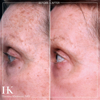 55-64 year old woman treated with TotalFX full face Fractional CO2 laser resurfacing - For more information on this procedure, please visit: https://www.drkhorasani.com/before-and-after-gallery/laser-skin-resurfacing