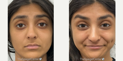 18-24 year old woman treated with Xeomin - Botulinum