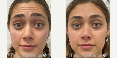18-24 year old woman treated with Xeomin - Botulinum