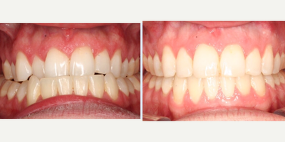 25-34 year old man treated with Clear Braces - Before and after clear braces