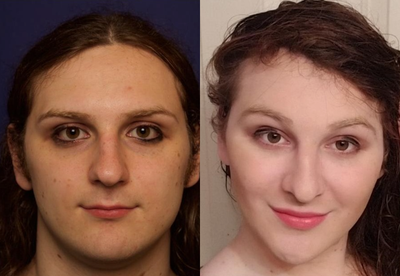 MTF Facial Feminization Surgery - FFSHairline Forehead Lift, Hairline Lowering, Orbital Bony ContouringRhinoplasty (possibly open) with Cartilage GraftsMalar/Submalar Cheek Implants- SmallChin Reduction/ ContourSubnasal Lip Lift with Fat AugmentationVoice Feminization