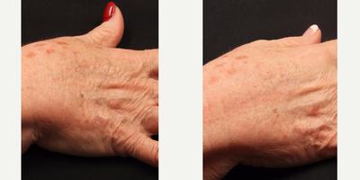 75 and up year old woman treated with Non-Ablative Laser Resurfacing - To help improve the appearance of sun-damaged hands, we recommended a combination of PhotoBody and Non-Ablative Laser Resurfacing treatments. 
This client saw amazing results. A visible reduction in brown spots and fine lines was achieved.