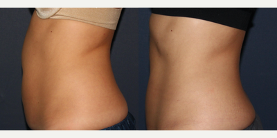 25-34 year old woman treated with UltraShape - Before and after UltraShape treatment for abdomen.