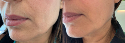 45-54 year old woman treated with Titan - Titan Jawline treatment:Titan utilizes a safe, infrared light to heat the dermis well below the skins surface. This heating can cause immediate collagen contraction resulting in tighter skin. During the procedure, the skins surface (epidermis) is protected through continuous cooling with the Titan hand piece. After the procedure, new collagen growth results in further tightening with the improvement of lax skin, folds and lines.After 6 Session.