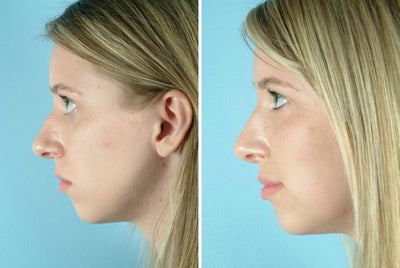 17 Year Old Female Treated for Nasal Deformity - 
	19 Year Old Female

	Diagnosis: Deformity of the Nose

	Procedure: Open Rhinoplasty&nbsp;
