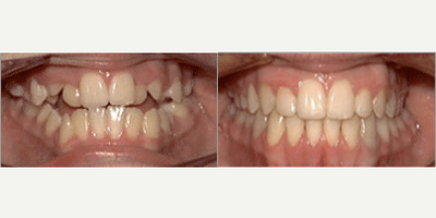 18-24 year old woman treated with Damon Braces - Damon Braces treatment