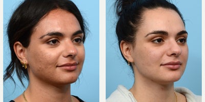 25-34 year old woman treated with VI Peel, Chemical Peel - This patient has completed 2 of 3 VI Peels, and the results are already showing. There's a visible improvement in both acne and acne scars.