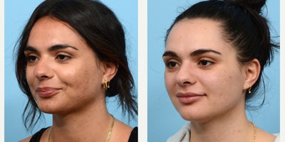 25-34 year old woman treated with VI Peel, Chemical Peel - This patient has completed 2 of 3 VI Peels, and the results are already showing. There's a visible improvement in both acne and acne scars.