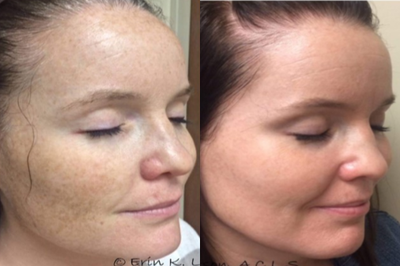 25-34 year old woman treated with Pixel Laser - Also uses quality physical sunscreen