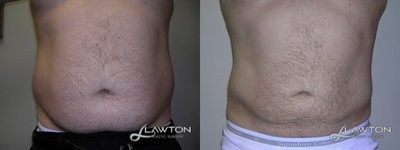 Male Liposuction - Follow Up Months: 3