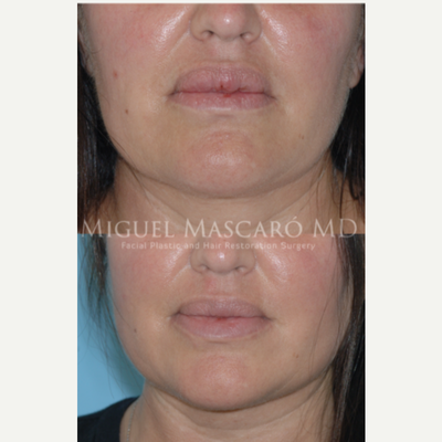45-54 year old woman treated with Lip Reduction - History of silicone injections in the lips, shown after one reduction of the upper lip to create adequate contour and balance