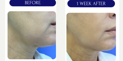 35-44 year old woman treated with Lipodissolve - lipodissolve injections