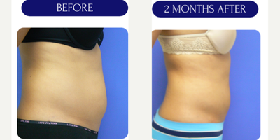 35-44 year old woman treated with Lipodissolve - lipodissolve injections