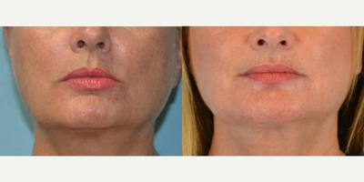 55-64 year old woman treated with ArteFill - 63 year old female received ArteFill to jawline, nasolabial folds and marionette lines