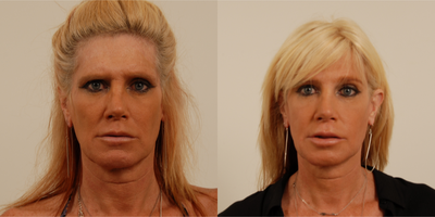 50 year old transgender woman underwent Facial Feminization Surgery - This 50 year old transgender woman underwent a foreheadplasty to soften her forehead features. Notice the amount of feminization just by improving the forehead appearance.
