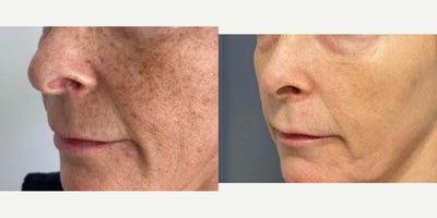 woman treated with IPL, Fractional Laser, Lumecca - Treated by laser technician Alyssa Gutierrez