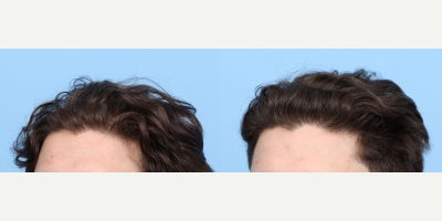 18-24 year old man treated with PRP Injections, PRP for Hair Loss - Prior to PRP hair loss treatment, this 21-year-old patient experienced significant hair thinning, visible scalp, and sparse follicles in certain areas. After three PRP sessions with Dr. Wise, he showed remarkable improvements, including enhanced hair density, thicker strands, reduced scalp visibility, and a fuller look, with noticeable regrowth in the previously thinning areas.