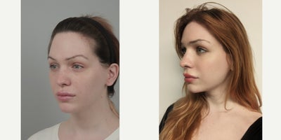 25-34 year old woman treated with AccuLift, Cheekbone Reduction, Contour Thread Lift, Facial Fat Transfer, Forehead Reduction, M - .