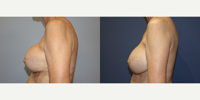 65-74 year old woman treated with Breast Implant Revision - This 72 year old woman had longstanding ruptured silicone gel implants with hard, painful capsular contractures. She underwent bilateral capsulectomies with removal of her old ruptured implants and scar tissue and replacement with IDEAL structured saline implants and insertion of ADM by Dr. Kalus. She was extremely pleased with her improvement.