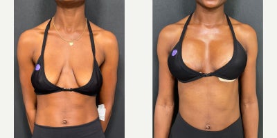 Breast lift with 255 cc- round implants - Breast lift with 255 cc round implants