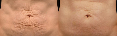 Woman treated with Skin Tightening - Woman treated with Skin Tightening