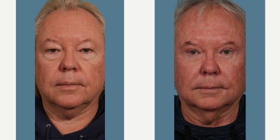 65-74 year old man treated with Eyelid Surgery, Botox, Juvederm, Sculptra - Our lovely patient had an upper and lower Blepharoplasty over 10 years ago! Over the years he has maintained his injectable treatments which has enhanced his surgical results. Combining injectable treatments with surgical procedures creates a more balanced, rejuvenated and long-lasting result for patients.