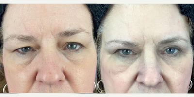 55-64 year old woman treated with Eyelid Surgery - Patients heavy eyelids were restricting vision. Performed bilateral upper blepharoplasty and bilateral brow pexy to open up eyes, thus enabling patient to see without eyelids impeding vision field.