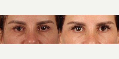 Eyelid Refresh - Blepharoplasty, Ptosis Repair and Erbium:YAG Fully Resurfacing - 53-year-old female with a history of previous full facial rejuvination surgery, who felt her eyes looked tired. Aside from some excess skin of her upper eyelids, her eyelids fell too low on top of her pupils (ptosis) and she had some loss of skin elasticity around her eyes. Comprehensive eyelid surgery was performed in office, under local anesthesia, including upper blepharoplasty, internal ptosis repair and fully ablative (TRL) Erbium:YAG laser resurfacing.