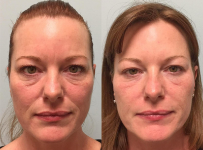 ALMI (Autologous Lipocyte Micronized Injection) for facial rejuvenation - This patient is seen here before and after facial rejuvenation with ALMI (Autologous Lipocyte Micronized Injection). ALMI is a technology that uses your own fat and stem cells to rejuvenate and revive different areas of the body, in this case for rejuvenation around the eyes and nasolabial folds.