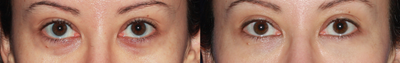 25-34 year old woman treated with Belotero - Patient underwent Belotero treatment of the lower eyelid area.
