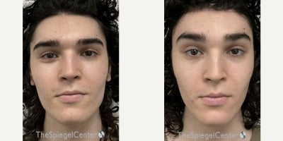 18-24 year old transgender man treated with Facial Feminization Surgery - 18-24 year old transgender man treated with Facial Feminization Surgery