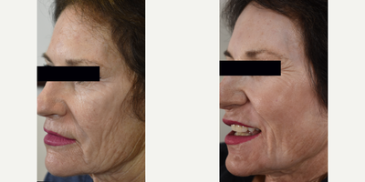 Los Angeles Laser Resurfacing - Sciton Microlaserpeel - traditional Erbium resurfacing. - Two weeks post second Microlaserpeel with the Sciton Erbium laser.  This is NOT fractional resurfacing, it is traditional full field and produces much better results for fine lines, wrinkles and sun damage than fractional lasers.