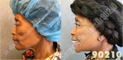 Woman treated with Facial Rejuvination - Woman treated with Facial Rejuvination