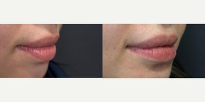 25-34 year old woman treated with Lip Reduction - Lower Lip Reduction surgery 7 weeks post operative