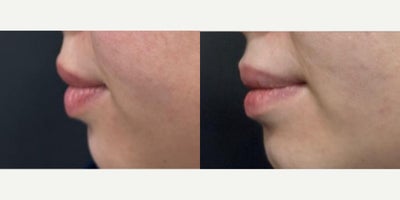 25-34 year old woman treated with Lip Reduction - Lower Lip Reduction surgery 7 weeks post operative