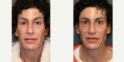 Laser Scar Treatment and Lip Lift - Laser for facial scarring with lip lift, tear trough filler, temple filler, and depigmented scar treatment.