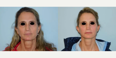 Woman treated with Mini Facelift - Before and 2 months after mini-facelift.