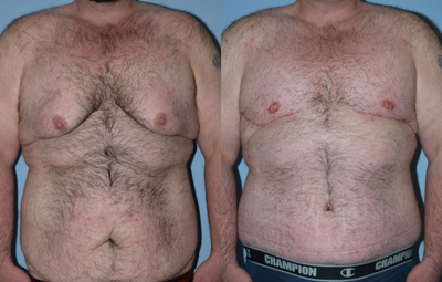 25-34 year old man treated with Male Tummy Tuck - Male tummy tuck and male breast reduction, 2 months postoperative.