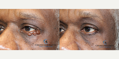 66 year old man treated with Eyelid Cyst Removal - 66 year-old man with multiple eyelid cysts. These cysts, known as hidrocystomas, are completely benign but extremely unsightly. Many patients seek out Dr. Chandler for his expertise with the precise and delicate technique required to remove these disfiguring facial growths. And these in-office surgical cyst removals are extremely close to the eyeball itself, Dr. Chandlers area of special expertise. The after photo is shown only 6 weeks after removal with no retouching as always. Some mild pigment change is seen in the healing excision areas, but Dr. Chandler expects this to fade even more over the next several months. The patient was thrilled and exclaimed to Dr. Chandler I had no idea it would turn out so good, I was sure I would have big scars, this is just amazing!