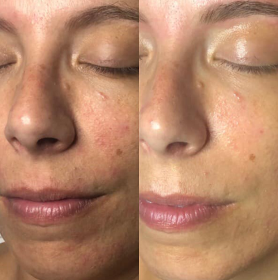 35-44 year old woman treated with DiamondGlow - Before and After of a Diamond Glow treatment
