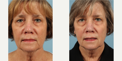 45-54 year old woman treated with Obagi Nu-Derm - 45-54 year old woman treated with Obagi Nu-Derm