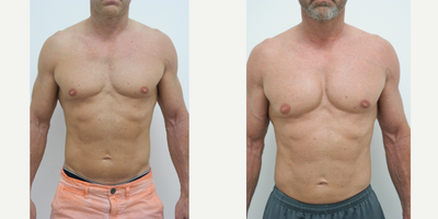 45-54 year old man treated with Pec Implants, Gynecomastia Surgery - 51 year old male 4 months after reduction of gynecomastia and pectoral implants performed by Dr Sam Gershenbaum.He had Implantec vertical rectangular soft solid silicone implants placed under the muscle, size 1, predominantly to provide fullness to the upper chest as requested. The gynecomastia was adequately corrected by liposuction. He was very pleased with his results.