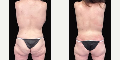 45-54 year old woman treated with Mommy Makeover, Breast Lift, Breast Fat Transfer, Body Lift, Tummy Tuck - Unveiling a new chapter of confidence 