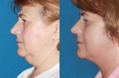 Neck Lift - 	Patient had a Face and Neck lift procedure.