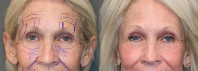 CO2 Laser and Stem Cell Fat Transfer - Laser resurfacing with fractionated CO2 and stem cell fat transfer.