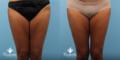 35-44 year old woman treated with Emtone - Reduction in thigh circumference after 4 treatments of Emtone